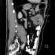 Colorectal cancer, carcinoma of transverse colon, lymphadenopathy, liver metastases: CT - Computed tomography